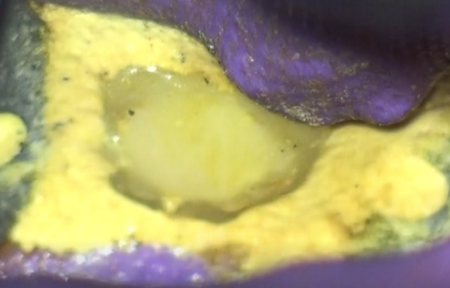 根幹治療の症例写真