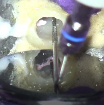 根幹治療の症例写真