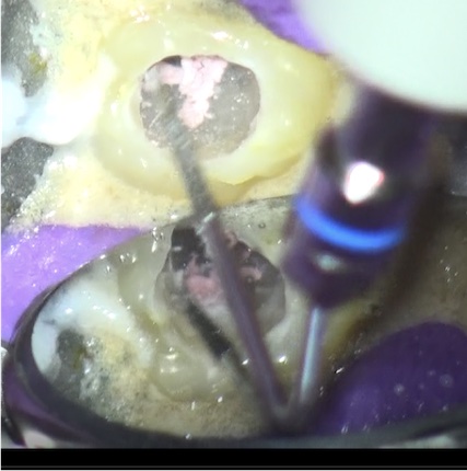 根幹治療の症例写真