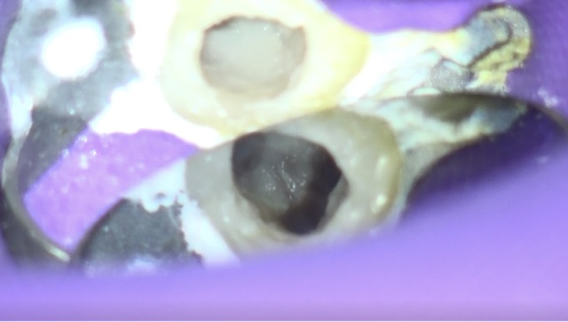 根幹治療の症例写真