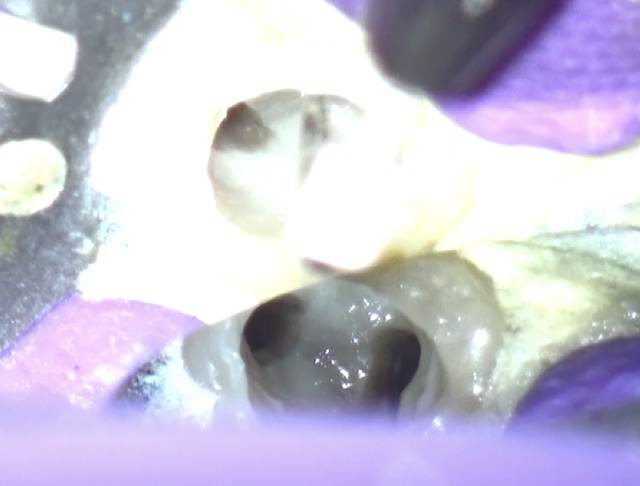 根幹治療の症例写真