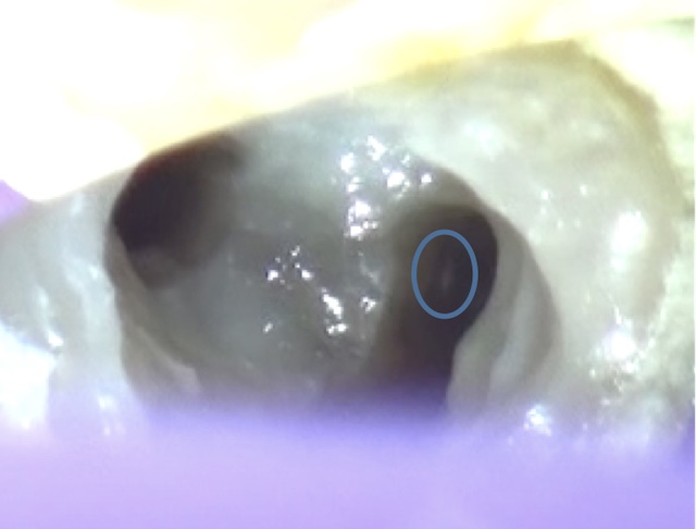 根幹治療の症例写真