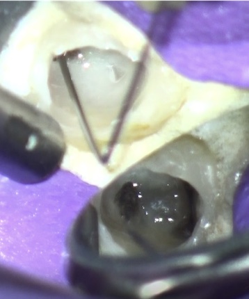 根幹治療の症例写真