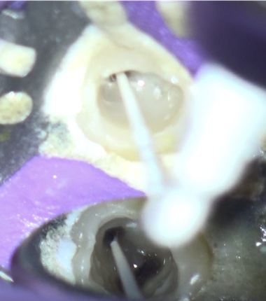 根幹治療の症例写真