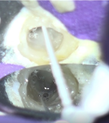 根幹治療の症例写真