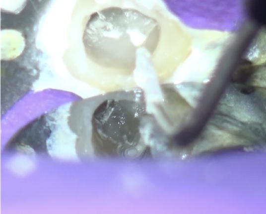 根幹治療の症例写真