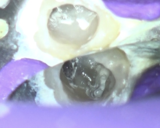 根幹治療の症例写真