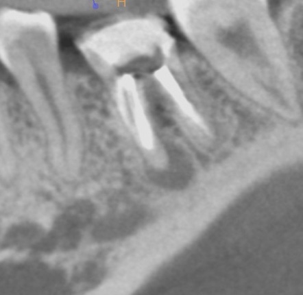 根幹治療の症例写真