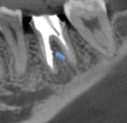 根幹治療の症例写真