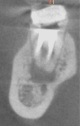 根幹治療の症例写真