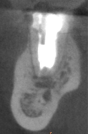 根幹治療の症例写真