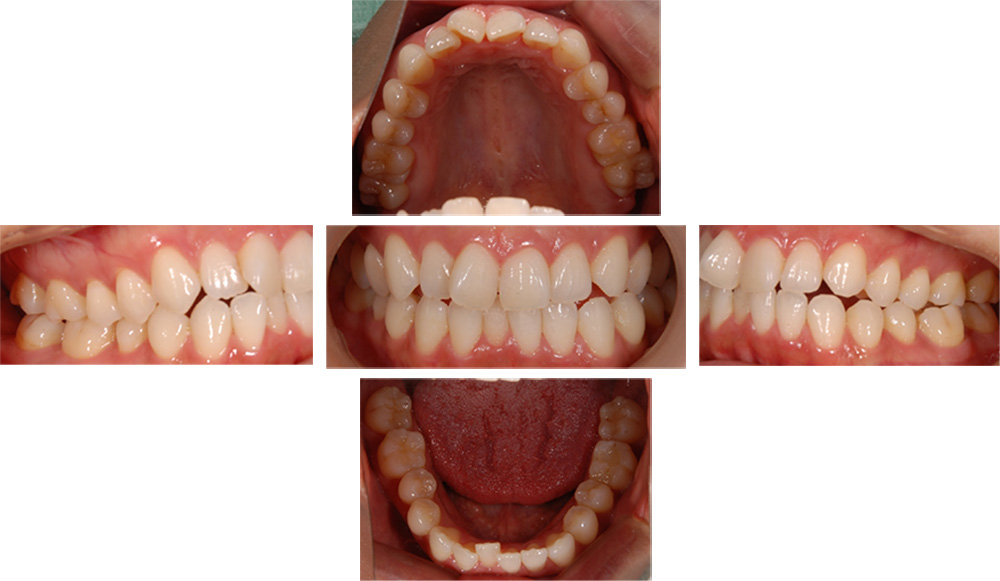 全顎矯正の症例写真（治療前）