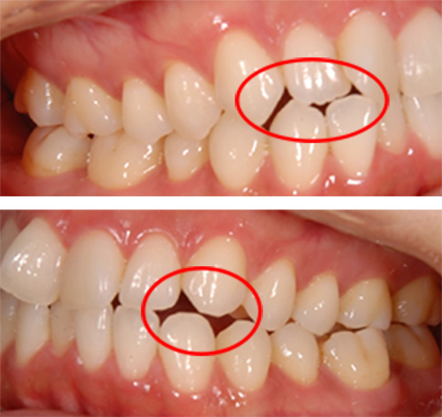 全顎矯正の症例写真（治療前）