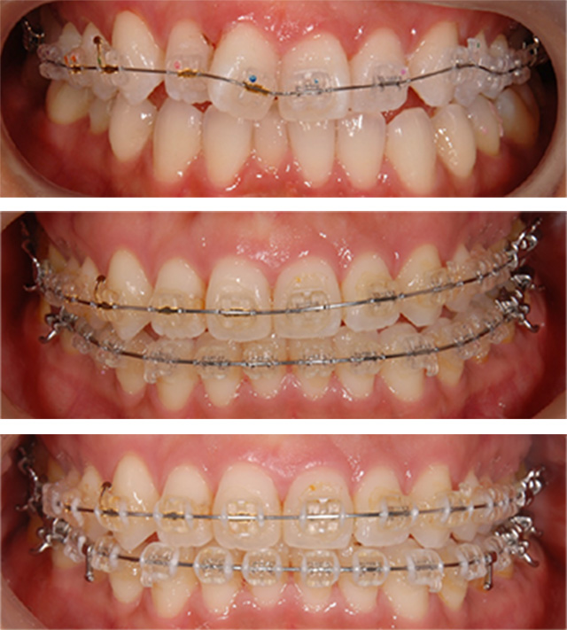 全顎矯正の症例写真（治療中）