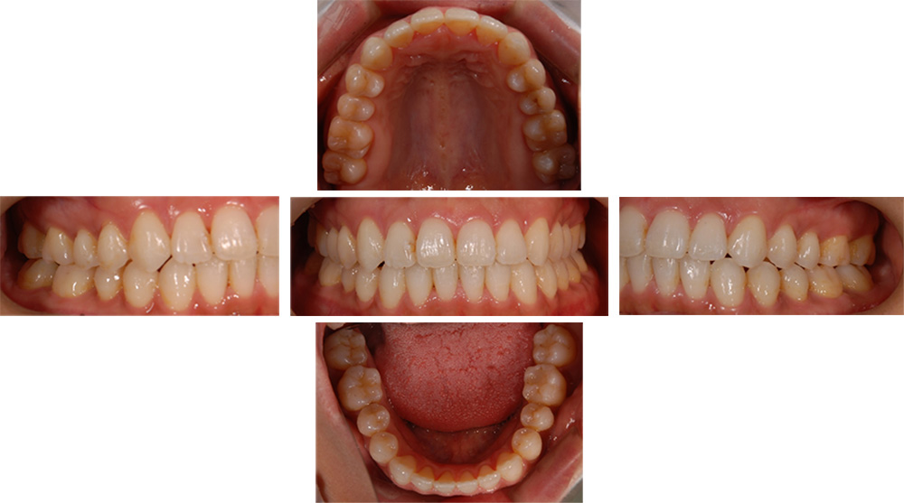 全顎矯正の症例写真（治療後）